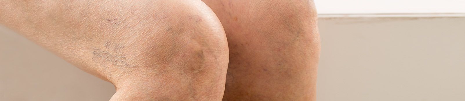 Quais-as-problematicas-em-torno-das-varizes