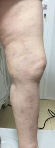 casos reais varizes - clinica de cirurgia vascular no porto - tratamento de varizes e derrames - 03D